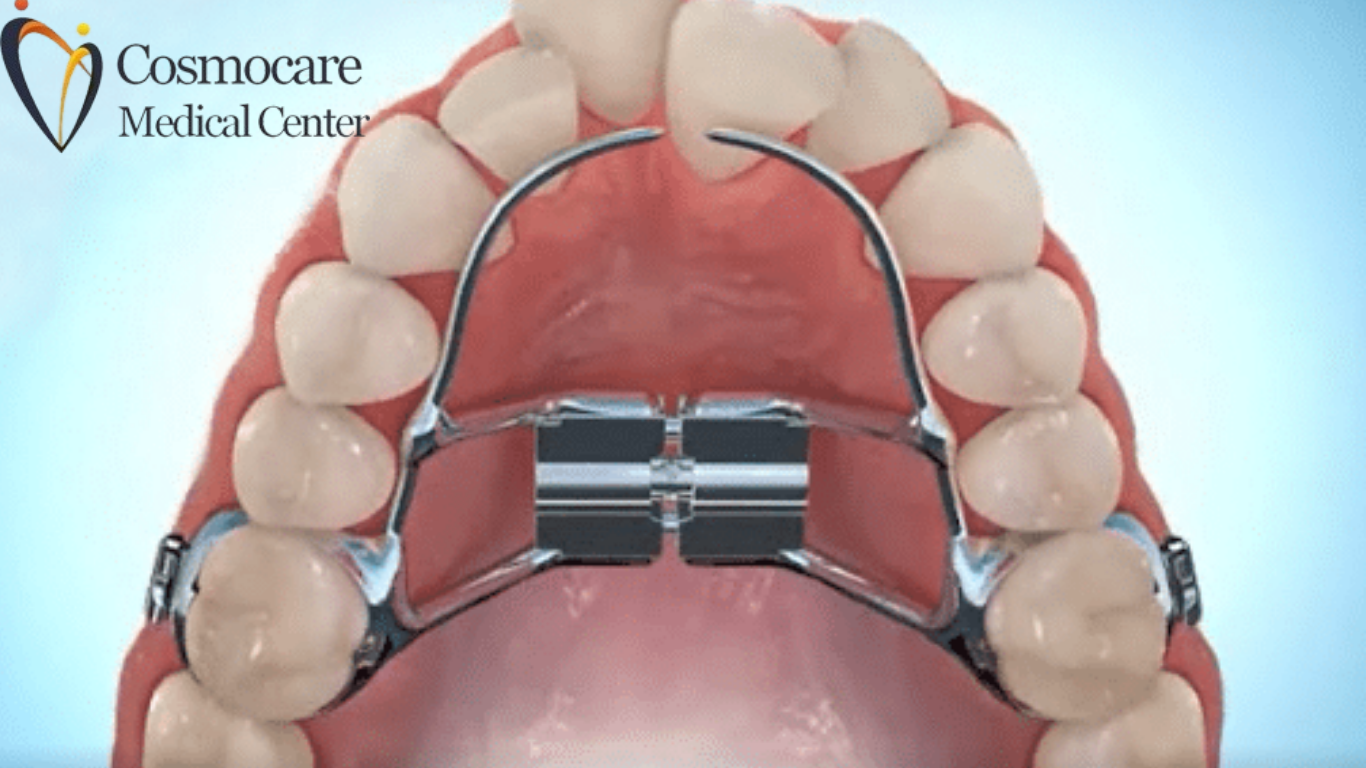 Palatal Expander Treatment Dubai by Cosmocare Medical Center